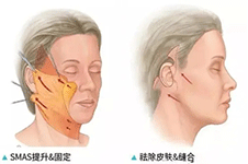 面部提升不简单 丽颖医院吸脂与埋线同时进行