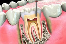 根管治疗后是否要戴牙套，为什么有的医生建议不戴牙套？
