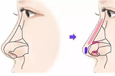 隆鼻术后的10大注意事项，想要鼻子恢复的好一定要牢记！