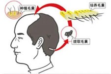 三亚华美植发技术怎么样？廖小飞医生有十几年的植发经验