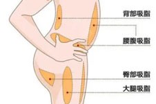 ?？诿揽ё罂♂t(yī)生吸脂技術(shù)好不好？擅長大腿腰腹環(huán)吸！