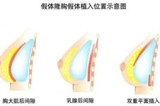 陳新平假體隆胸做的怎么樣？整友評價胸型特別自然！