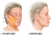 王浩宇医生拉皮技术怎么样，好不好？通过整友评价来了解