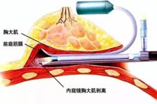 韩国DA整形隆胸技术怎么样？听说假体隆胸技术特别好！