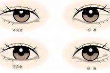 韩国赫拉眼整形技术好不好？李丙玟院长做眼睛很出名！
