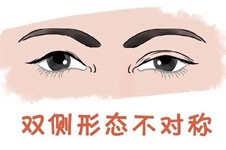 韩国OM眼整形技术好不好？双眼皮眼修复技术很出色！