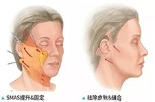 广州聂云飞做拉皮手术好吗？SMAS除皱术成效明显！