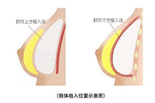 韩国赫拉整形隆胸技术怎么样？假体隆胸脂肪隆胸都不错！