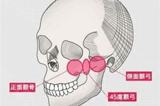 韩国COOKI郑成模改脸型技术怎么样？颧骨整形有特色！