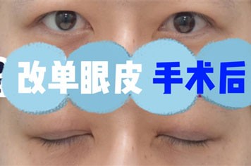 ​韩国来丽整形双眼皮改单眼皮+眼皮凹陷矫正手术分析！