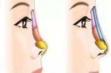 韩国玛博尔隆鼻技术如何？个人风格定制鼻型颇受好评！