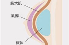 深圳米兰柏羽隆胸怎么样？擅长定制隆胸假体品牌齐全！