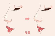 韩国博朗温整形做鼻子有名吗？整友评价隆鼻技术很赞！