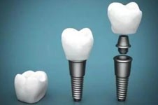 ​广州牙科收费价目表2023分享，含种植牙正畸牙齿修复费用