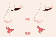 ​深圳南华西晶整形值得推荐，颅面部整形鼻修复技术呼声很高！