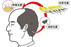 深圳悦尔医美植发凭实力出圈，3D微针植发技术很受欢迎！