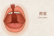 韩国唇腭裂修复有名的医生：千万家庭推荐柳济圣院长！