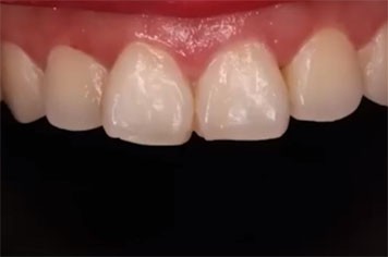 牙齿粗糙什么原因？韩国MINISH牙科口腔修复全过程曝光！