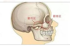 一针降颧骨是什么原理,我在杭州艺星做了一针降颧骨还可以!