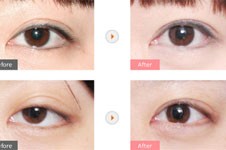 韩国格瑞丝噢爱美整形做眼睛怎么样,还你大而清晰的双眼皮!