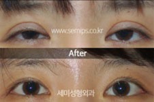 韩国朴相炫修复双眼皮案例,3W+体验韩国出名眼修复医生同款!