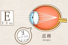 西安近视手术价格一览表！