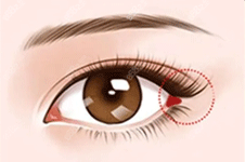 眼综合手术是什么？眼综合手术包括哪些项目？