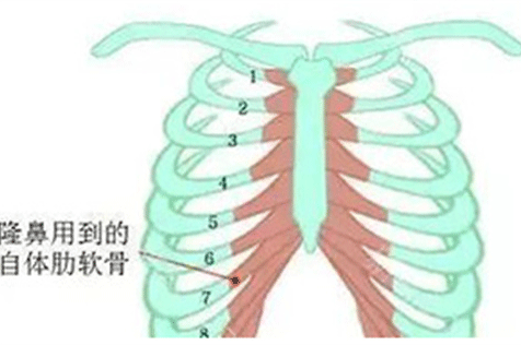 肋骨隆鼻可以维持一辈子吗？肋骨隆鼻的后遗症有哪些？