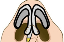 鼻小柱矫正可以单独修复吗？具体情况具体分析！
