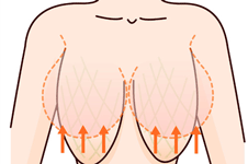 胸型水滴型和下垂型怎么区分？下垂型胸部如何改善？