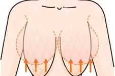 大胸缩小术是怎么做的？大胸缩小手术方式具体分析！