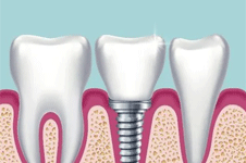 种植牙过程是怎样的？种植牙全过程详细讲解!