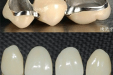 烤瓷牙和全瓷牙哪个好区别有哪些？从材质价格具体分析！