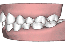 骨性地包天和牙性地包天有什么区别？怎么判断骨性和牙性
