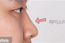 韩国FACELINE男性眼鼻整形分享，前后对比变化大！
