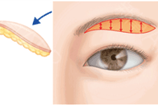 眼皮下垂提眉好还是割双眼皮好，不同的人群改善方法不同
