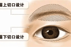 切眉术的手术方法有几种，切眉术的优势有哪些？