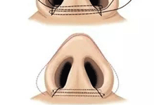 垫山根和隆鼻有什么区别？