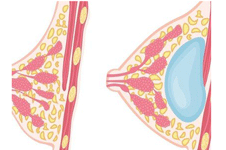假体隆胸为什么会出现包膜挛缩？
