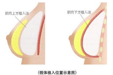隆胸的植入方式有几种？
