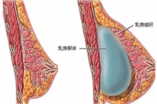 假体隆胸下皱襞切口和腋下哪个好？