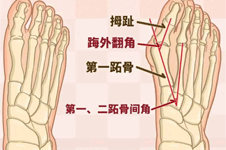 大脚趾拇外翻的危害有哪些？