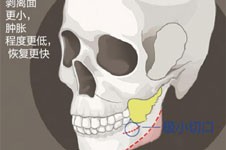 下颌角手术怎么做的呢？
