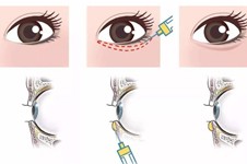 眼部卧蚕整形怎么做的？详细解析卧蚕手术有几种方法！