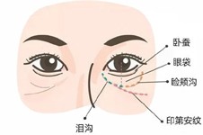 泪沟与眼袋的区别图，一招教你分辨并改善泪沟与眼袋！