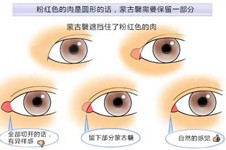 眼角修复真的很难吗？揭秘眼角修复的方法有哪些！