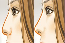 隆鼻方法有哪几种？教你判断隆鼻整形哪种好！