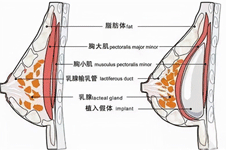 了解胸部包膜挛缩怎么修复！