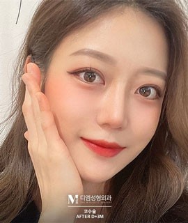 韩国迪美整形眼鼻综合手术惊艳众人！