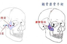 颧骨高做什么手术？该如何选择？